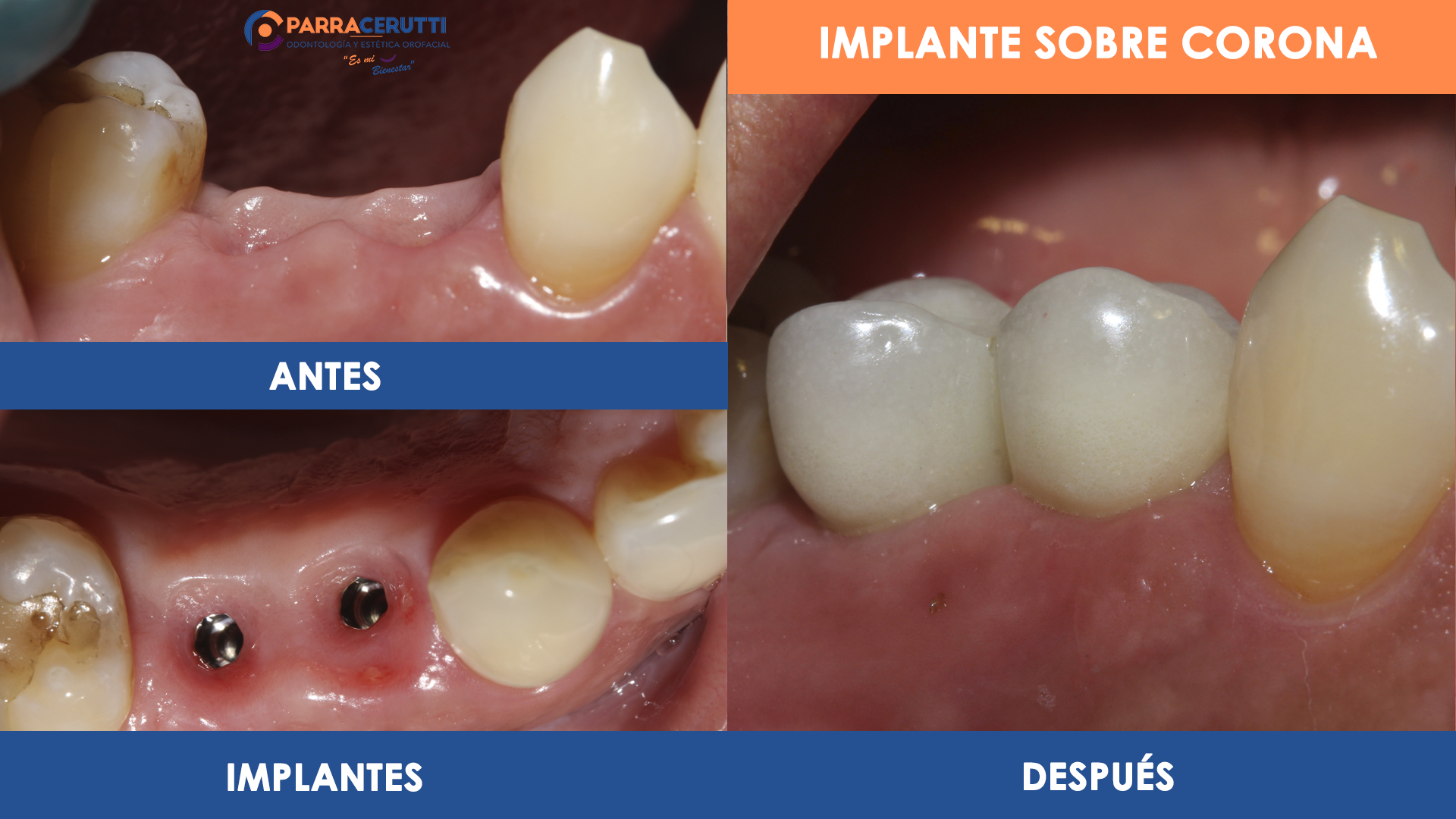 Implantología - Clínica ParraCerutti